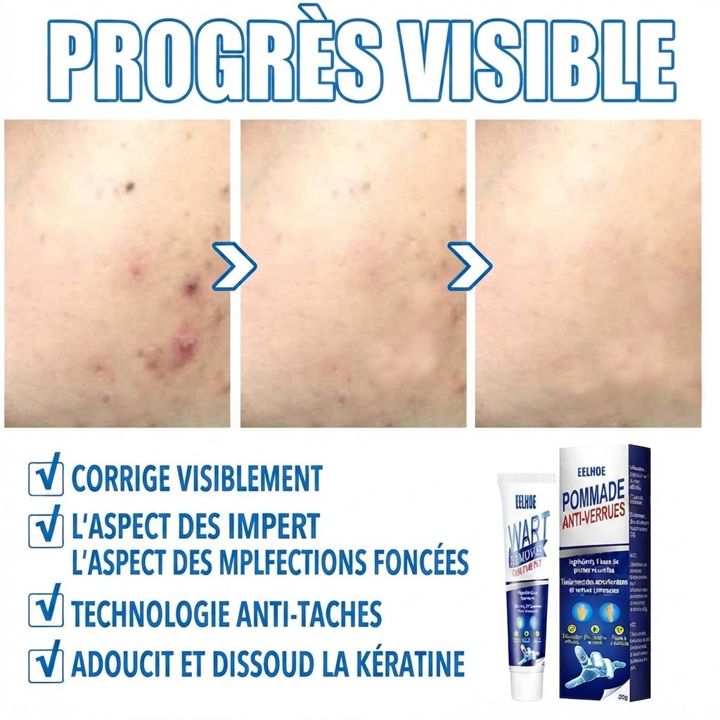 Crème Anti-Verrues & Soin Cutané