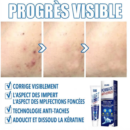 Crème Anti-Verrues & Soin Cutané